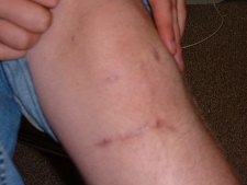 The scar on my knee months after ACL surgery