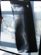 X-ray of my broken arm