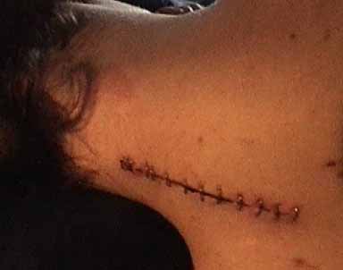 I have a lot of staples in my neck.
