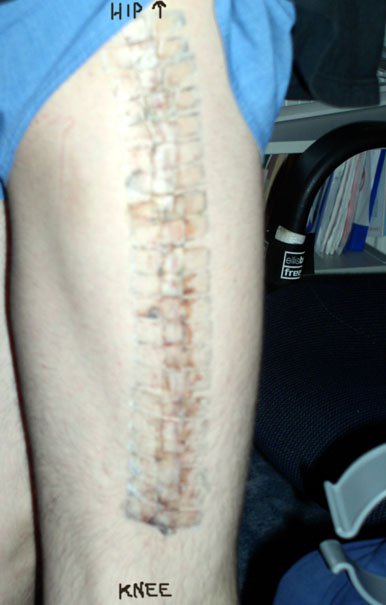 Thigh after plate was removed