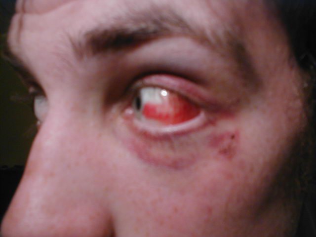 My latest eye injury.