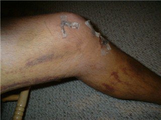 my knee injury