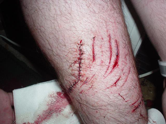 47 stitches after putting leg through windsheild of an excavator
