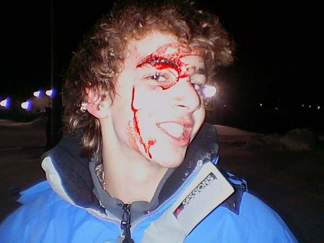 this is what you get when you smash your face on a rail with a helmet