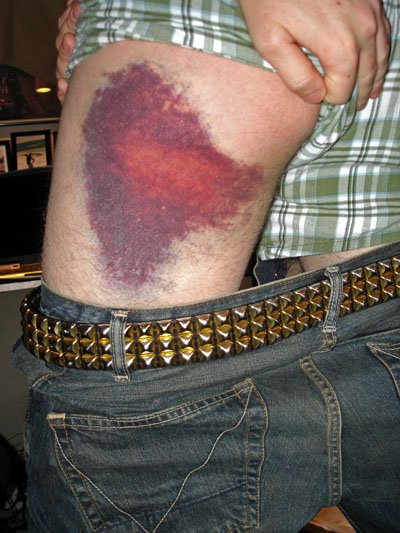 A Bruise that garrett got from attempting a gap box at Keystone