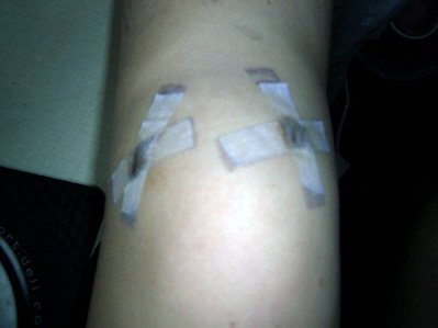 knee after scope