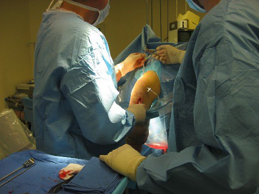 ACL surgery-in-progress