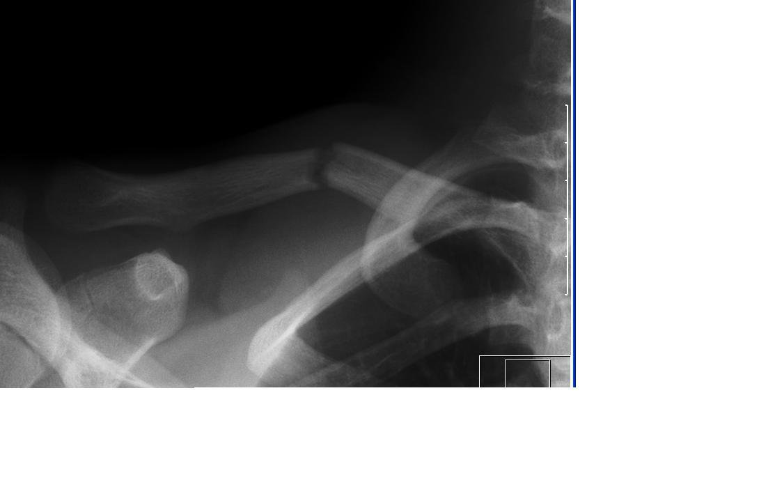 broken coller bone