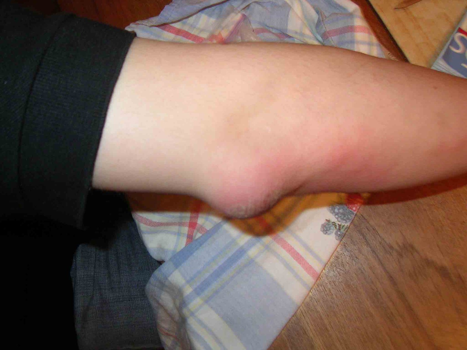 elbow after felt down in the stairs