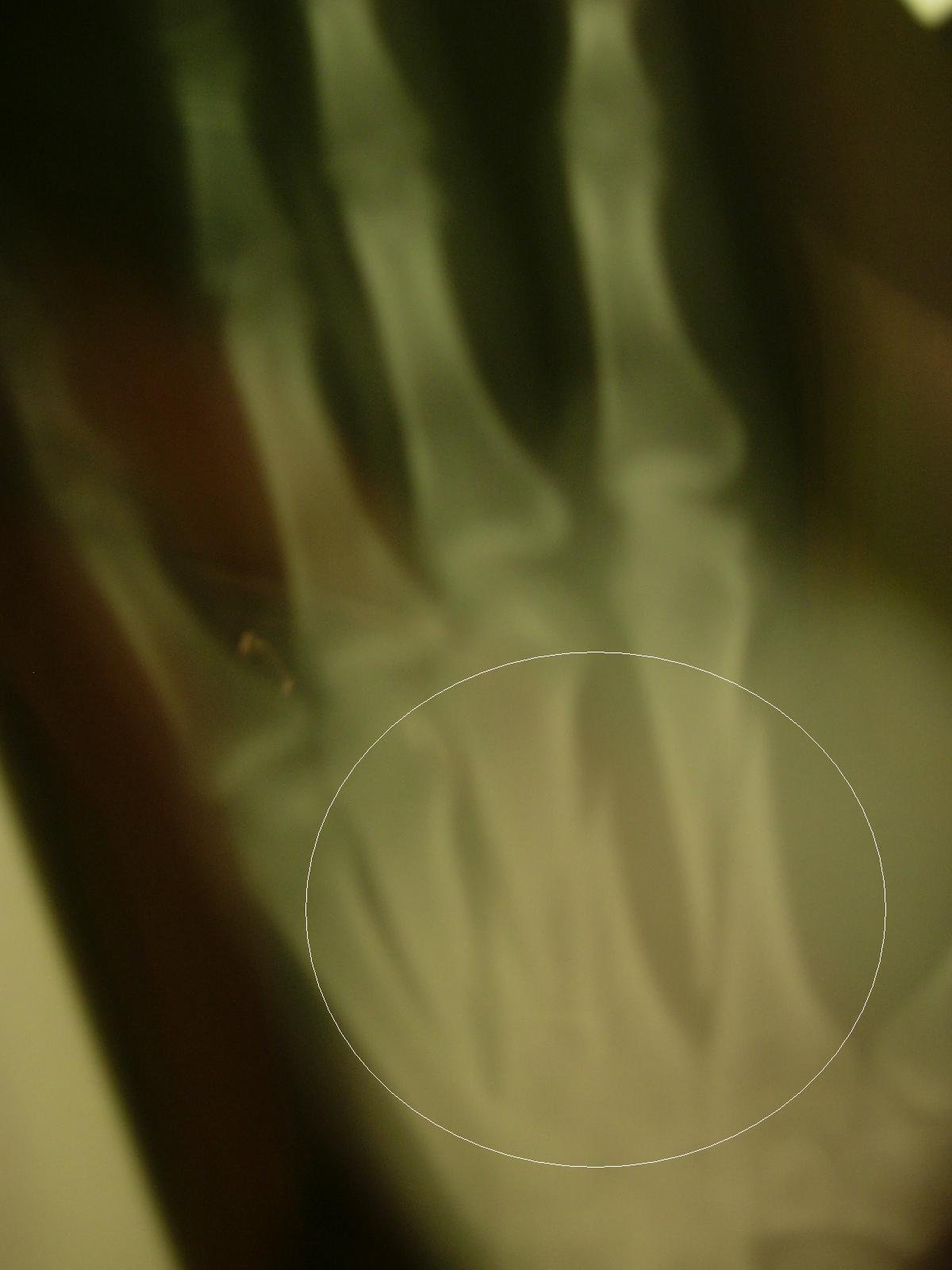 zavs severely broken hand