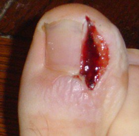 an in-grown toe at its best
