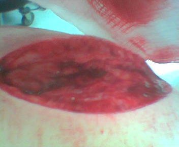 laceration