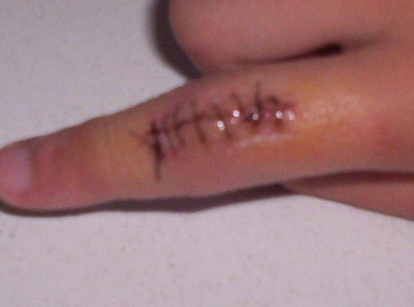 my finger after surgery
