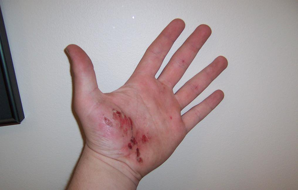 hand after falling on longboard (don't look if u dont like gross things)