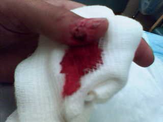 i cut off part of my thumb