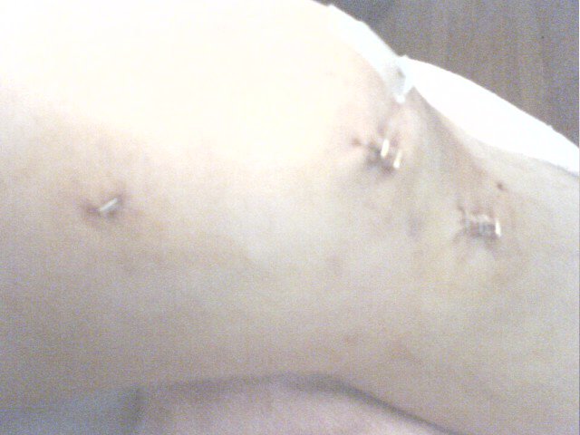 ACL Staples