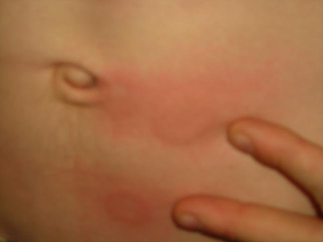 Welts from PING PONG BALLS