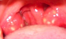 My tonsils