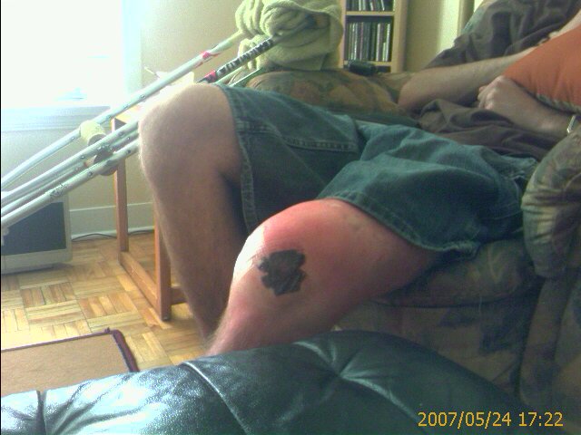 My knee after my menisqus surgery