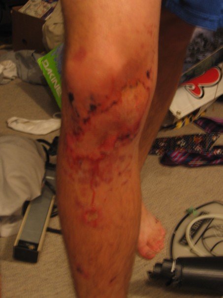 Burnt knee