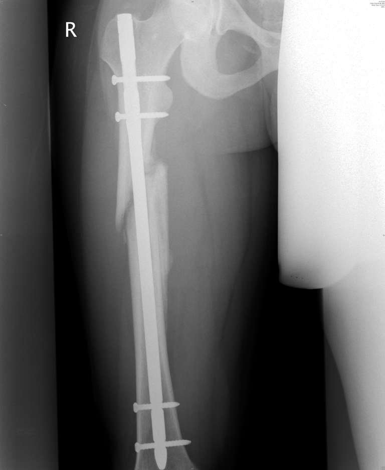 Broken leg - 4 of 4