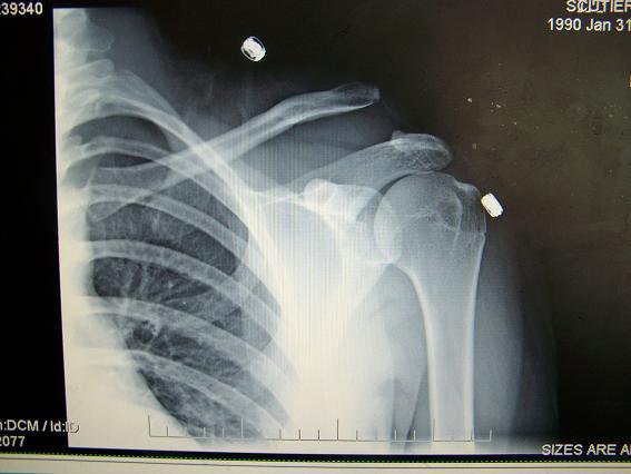 Broken shoulder