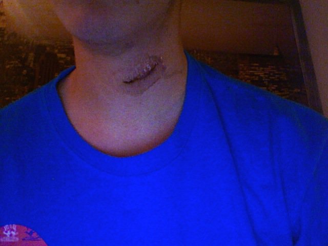 Scar from my surgery