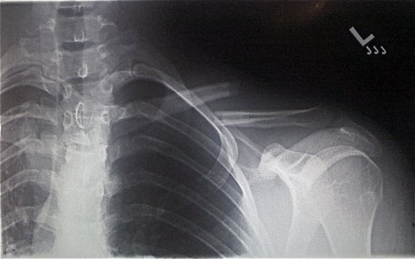 Broken Clavicle...