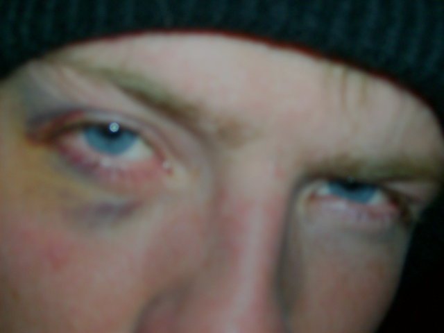 Black eye