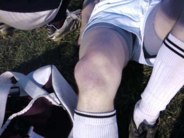 Friend's knee after rugby hit