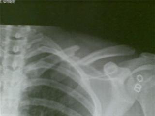 Broken collarbone.