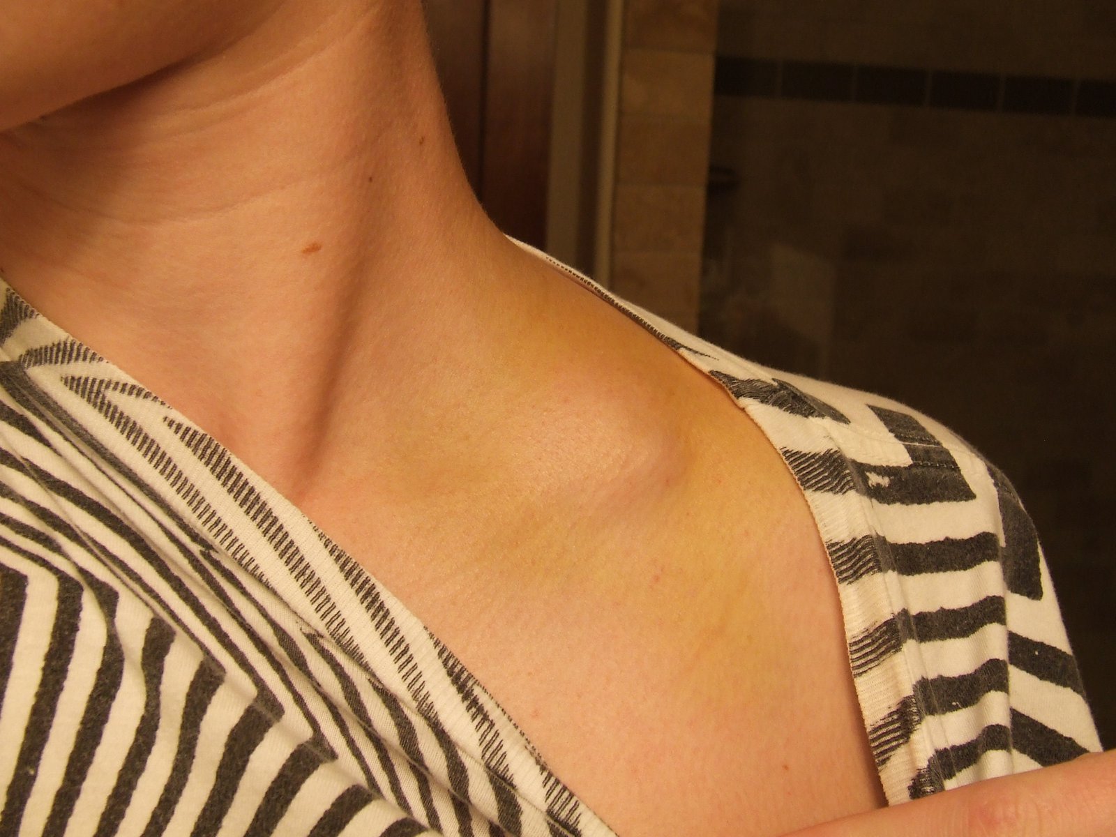 Broken collarbone