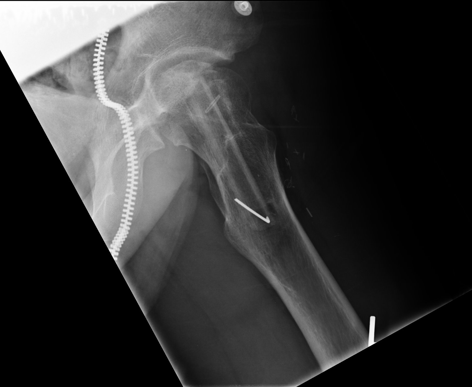 Free vascularized fib graft after Avascular necrosis