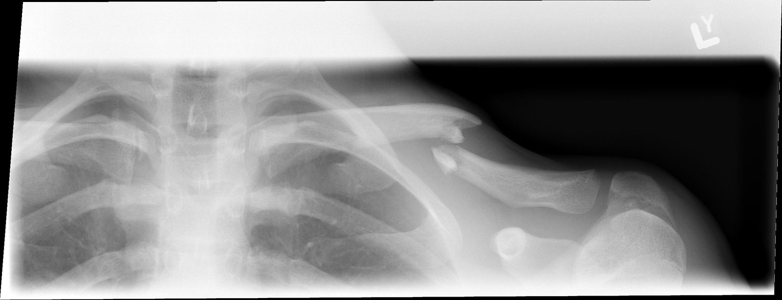 Broken c-bone