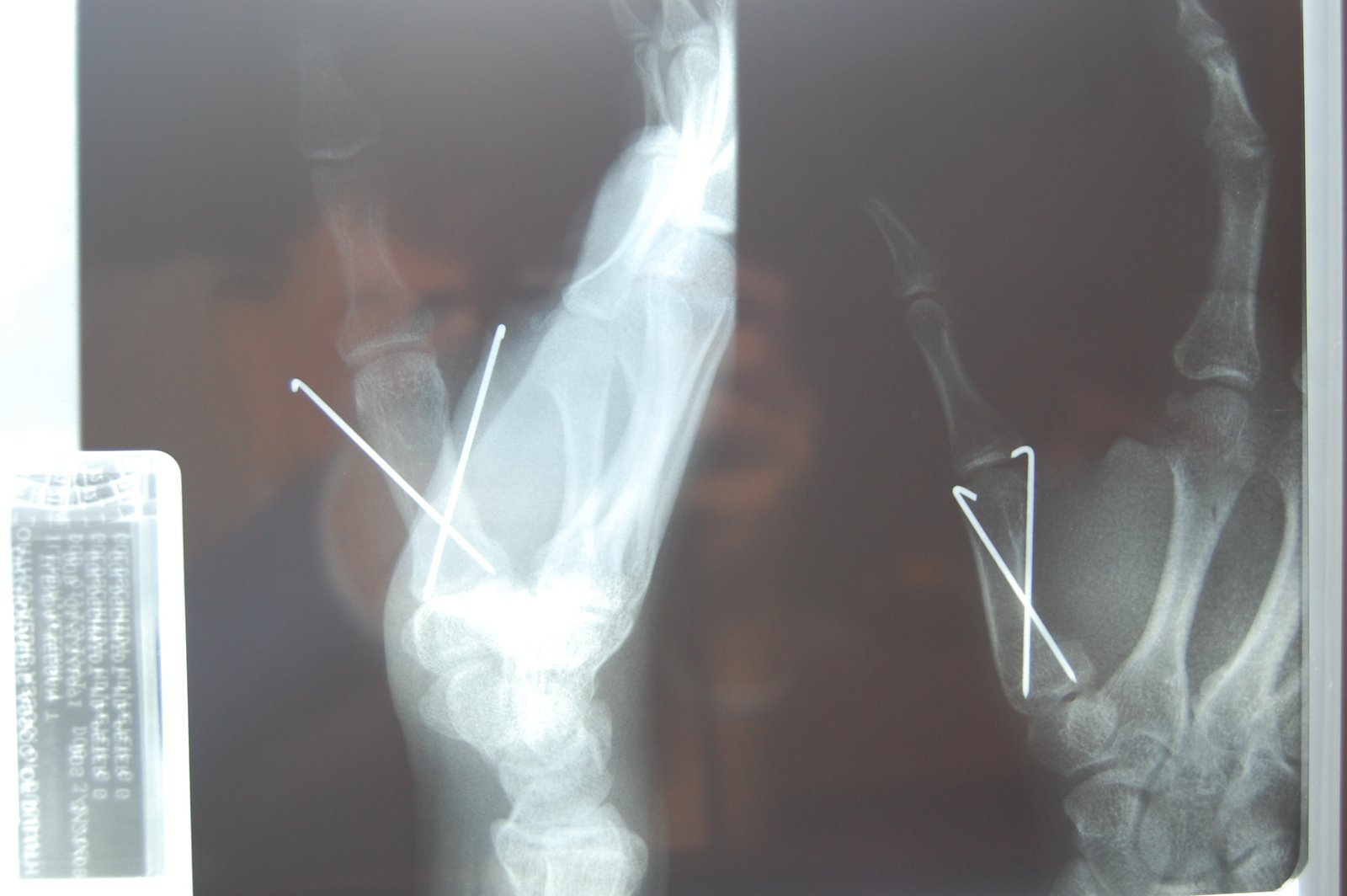 X-Ray