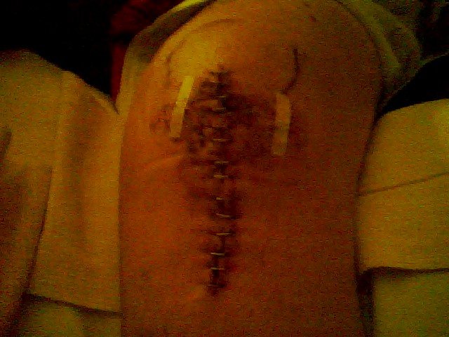 My knee afta surgry