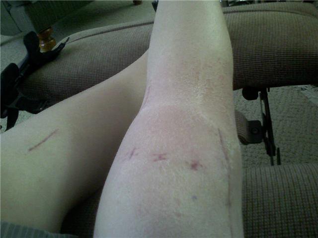Gross knee a few weeks after surgery