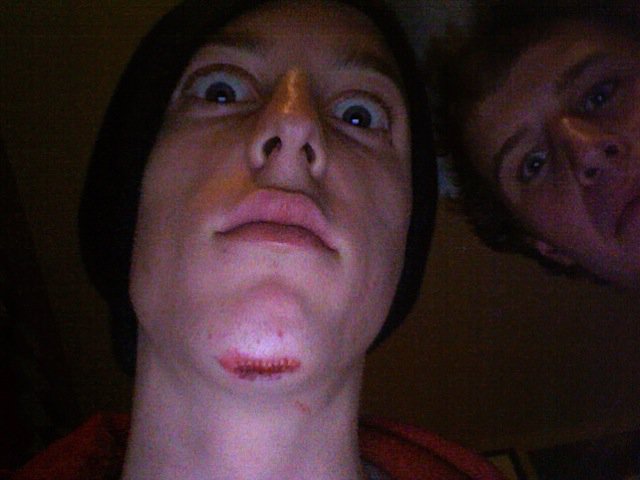 10 stitches and a broken jaw