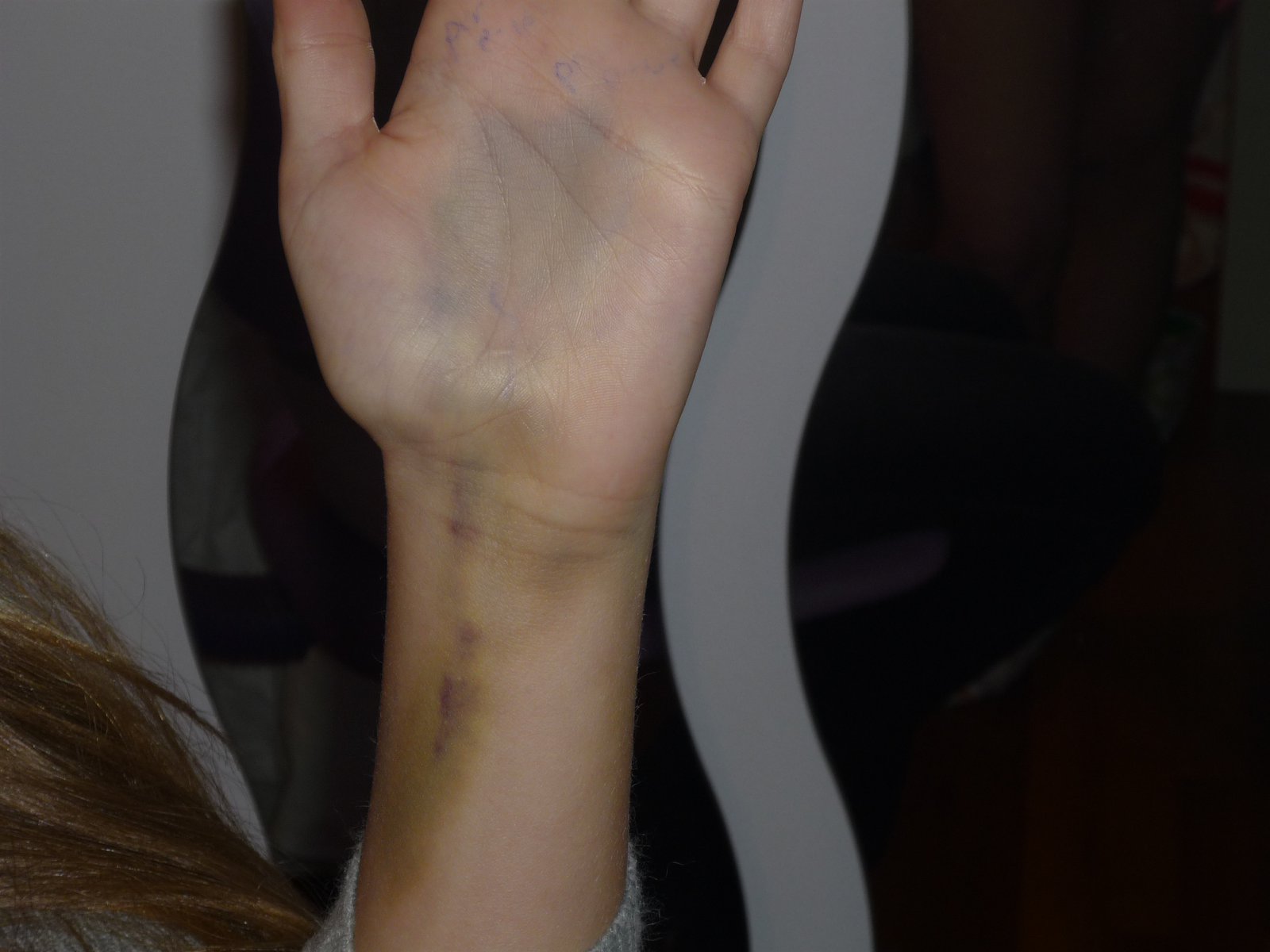 Broken wrist after 2 weeks