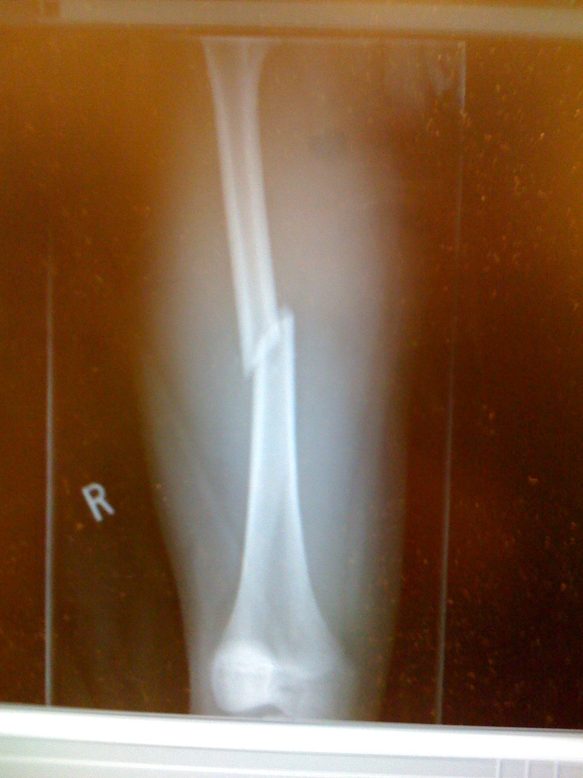 Femur Fracture