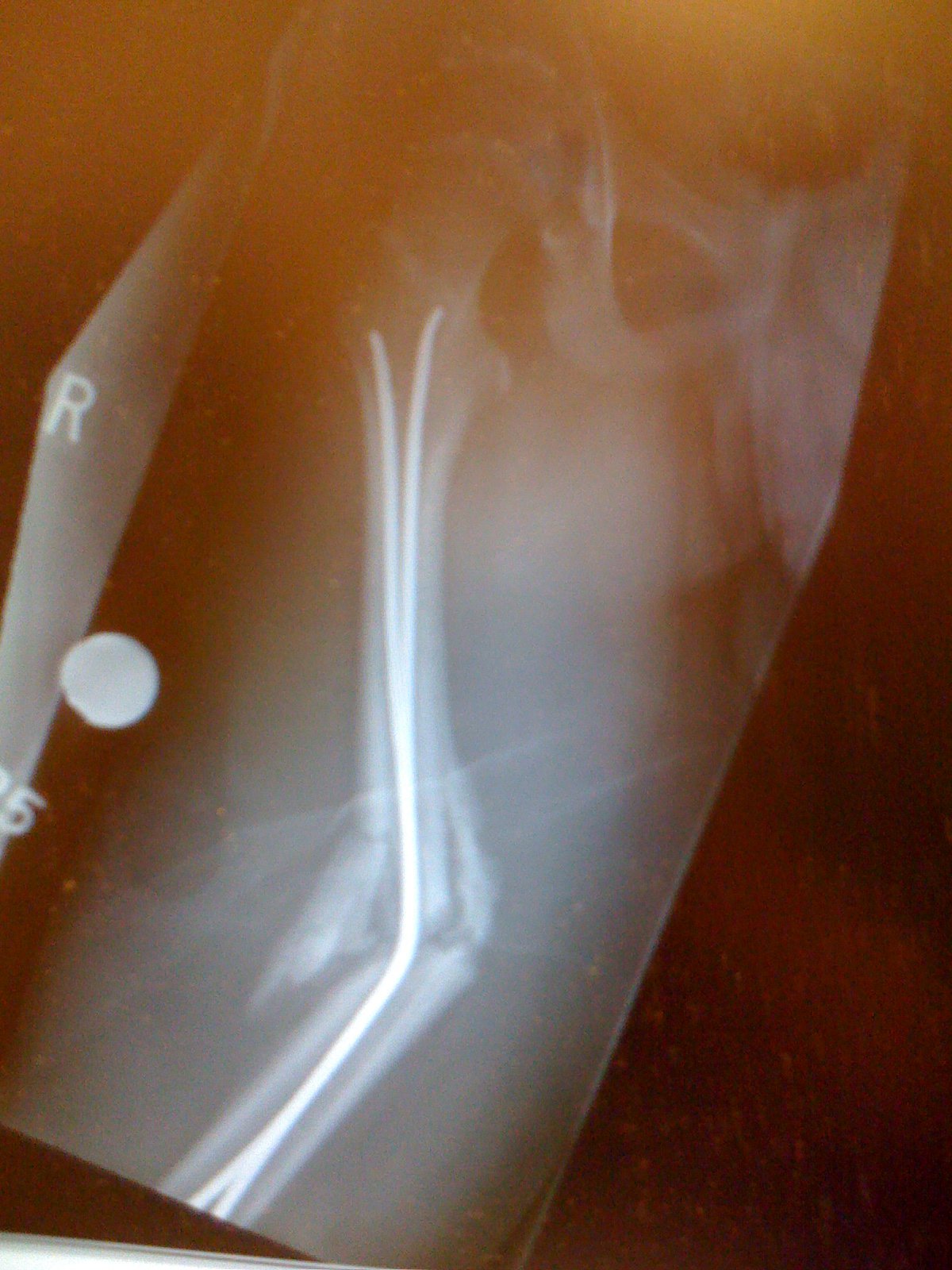 Second Femur Fracture