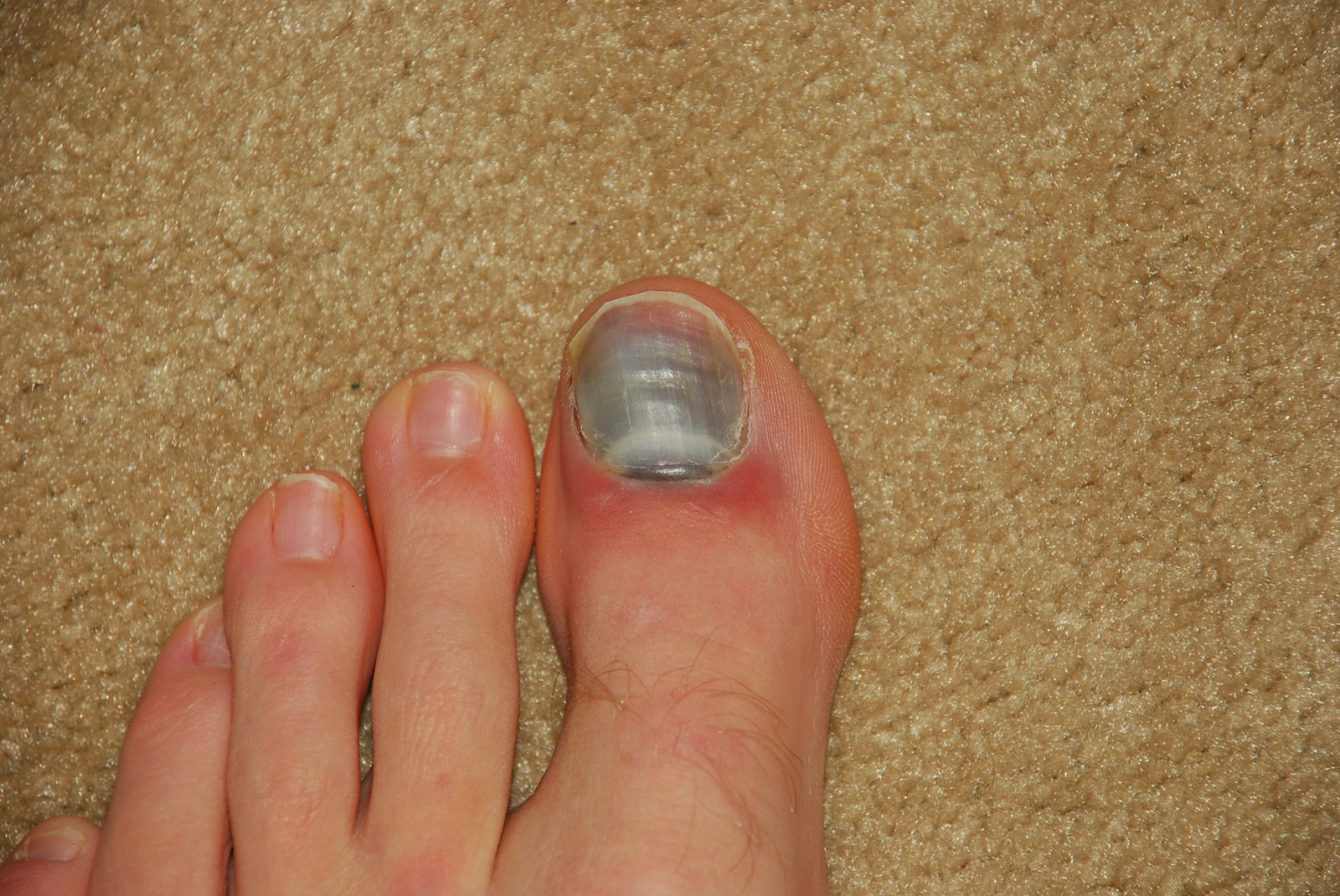 Toe about a week after it happened