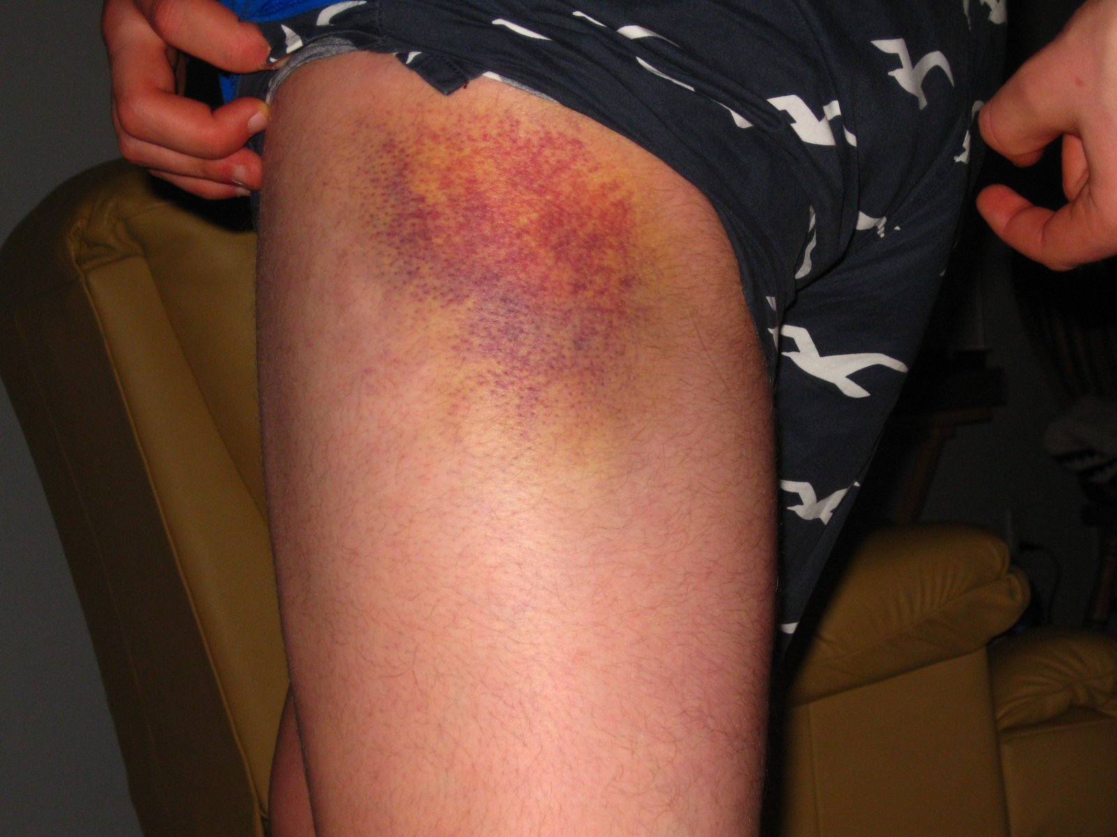 Metal + Leg = Gnarly Bruise