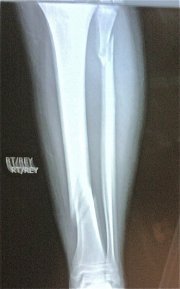 Broken Leg Xray