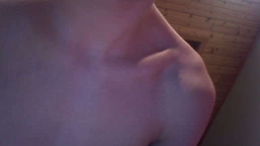 Not broken collarbone