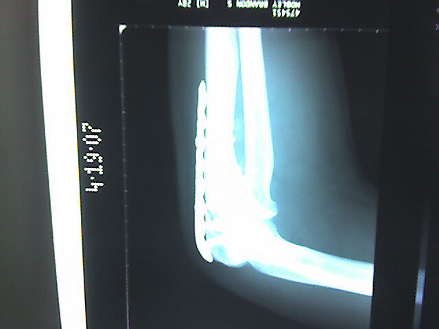 The plate that now resides in my elbow
