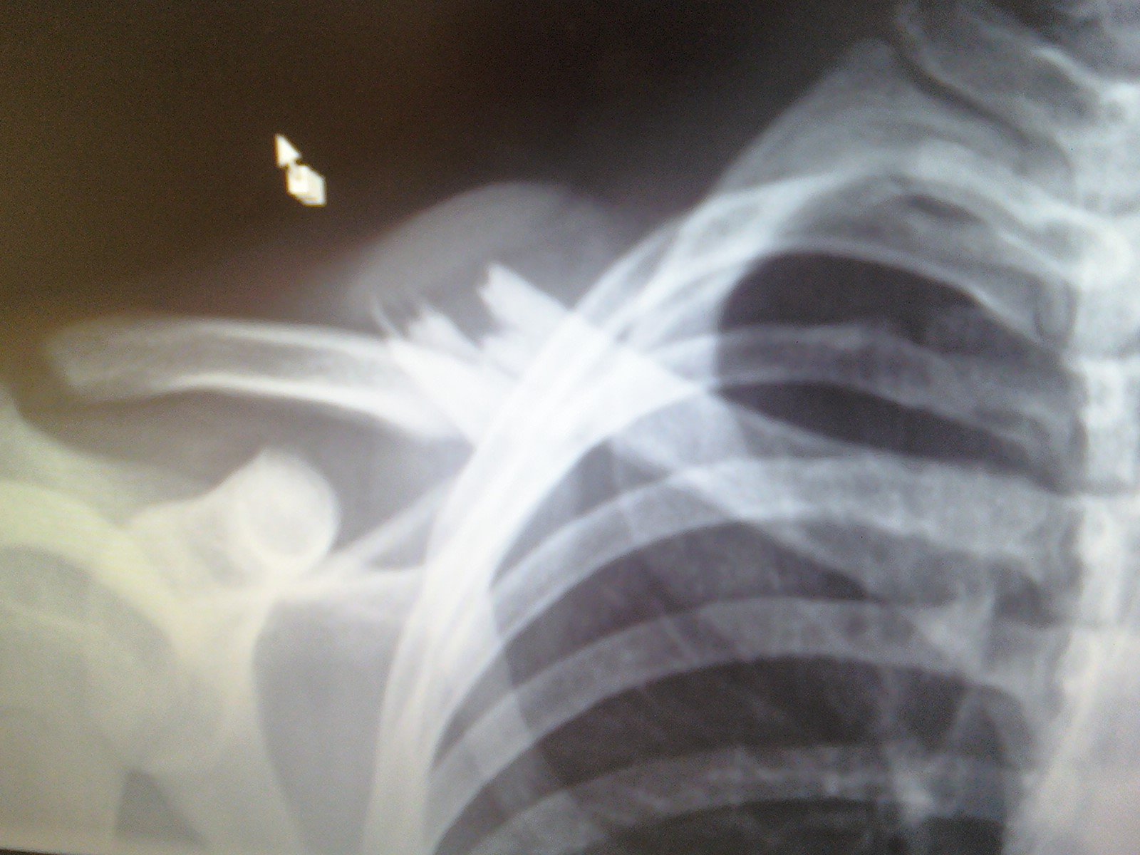 Collarbone broken in two spots