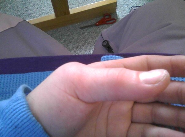 Dislocated thumb