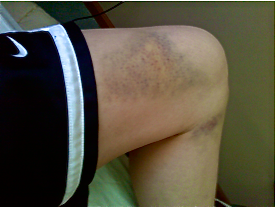 Ahahaa end of the season bruises