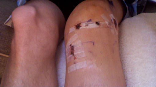 ACL, MCL, Meniscus